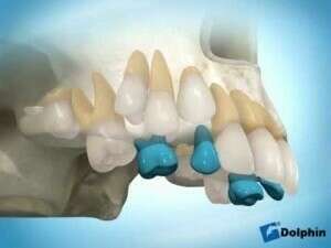 Extraction précoce  de dent de lait