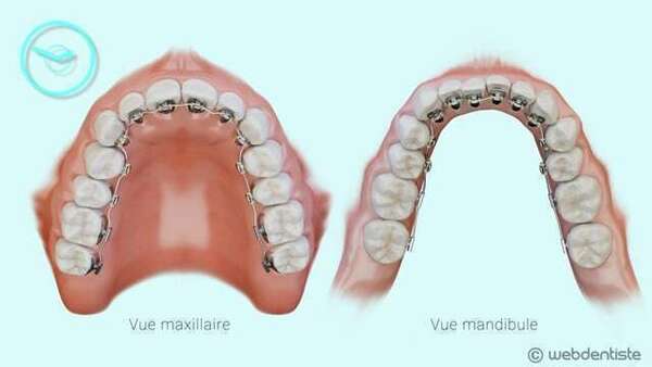 Appareil multi-attache lingual