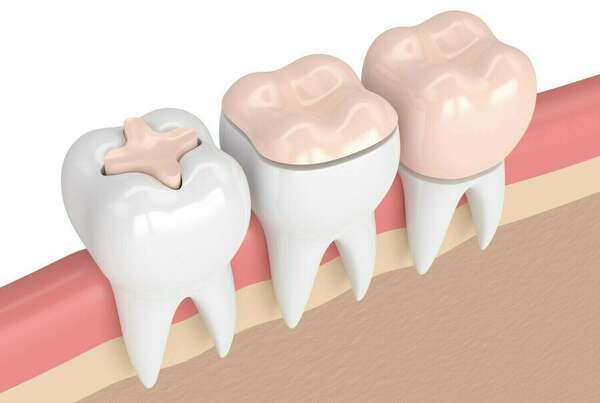 Inlay et onlay, une technique conservatrice