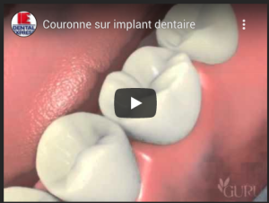 Couronne sur implant dentaire