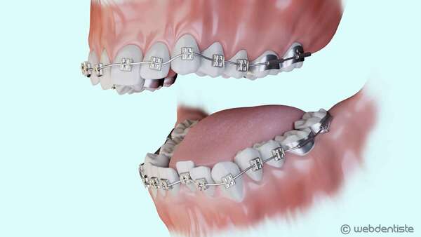 Traitement multi-attaches