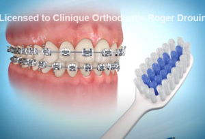 Brossage avec des "broches"