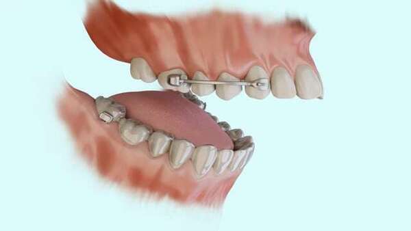 Le dispositif de carrière