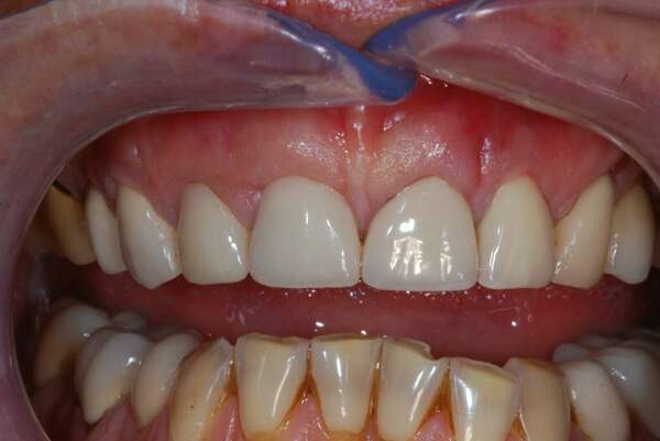 GREFFE GENCIVE- Dr JEAN DE MALBOSC