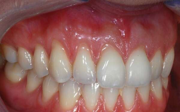 GREFFE GENCIVE - Dr JEAN DE MALBOSC