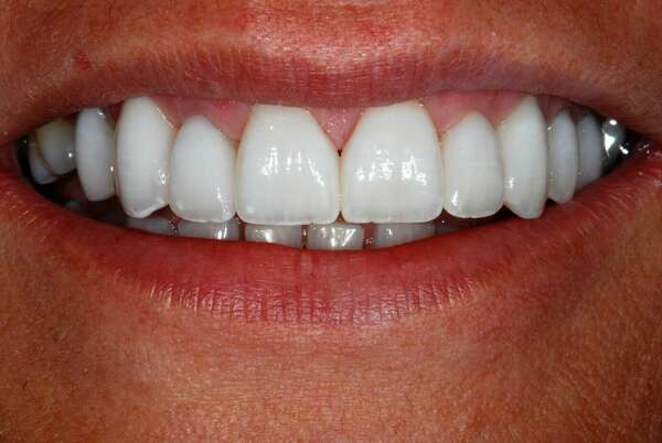 FACETTES CÉRAMIQUES - DR JEAN DE MALBOSC