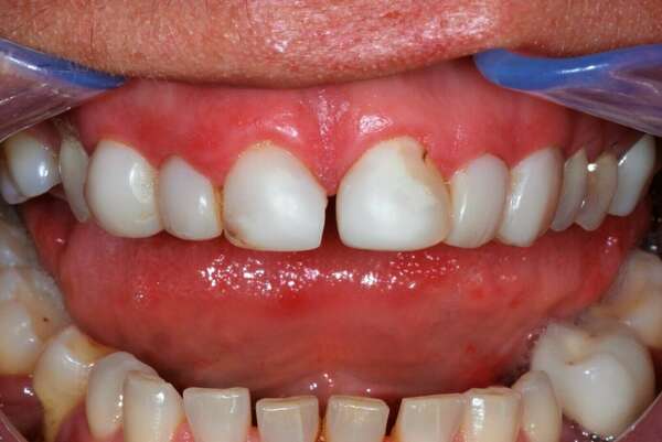 FACETTES CÉRAMIQUES - DR JEAN DE MALBOSC 2