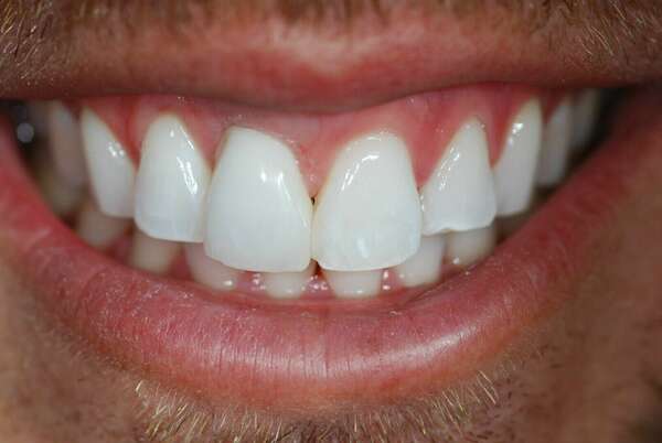 IMPLANT DENTAIRE - DR JEAN DE MALBOSC