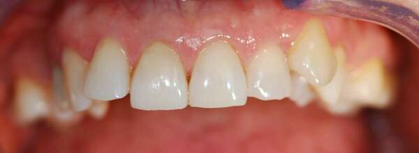 BLANCHIMENT DENTAIRE- DOCTEUR JEAN DE MALBOSC