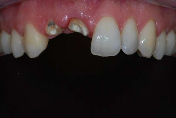 2 COURONNES SUR INCISIVES - Dr JEAN DE MALBOSC