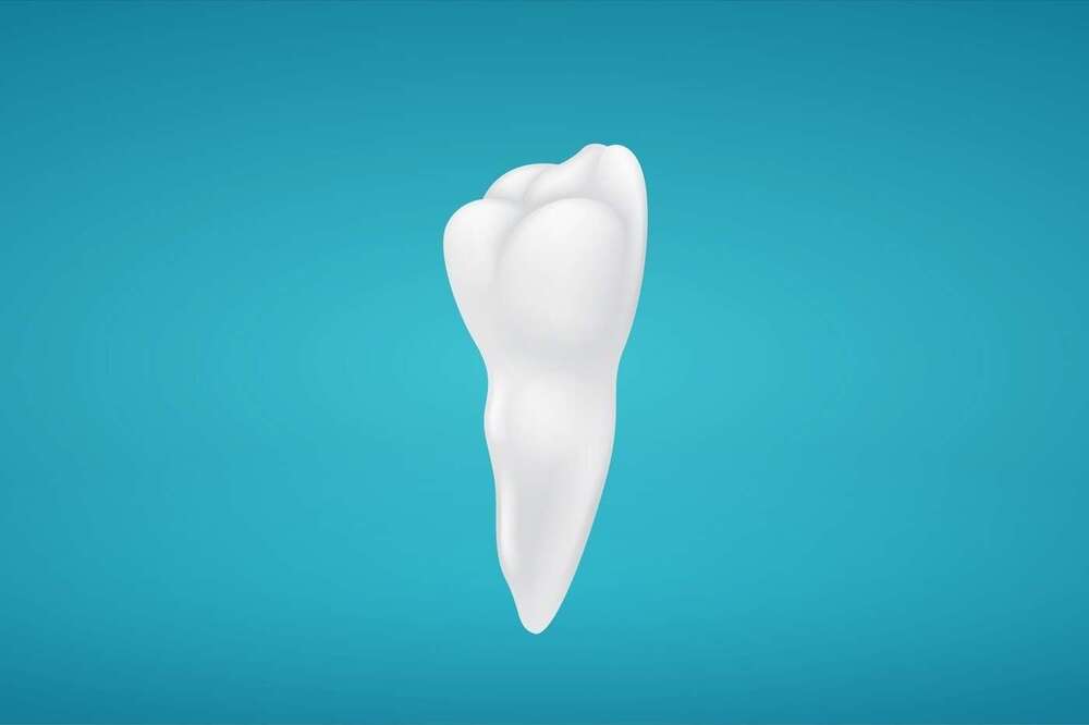 Dégagement orthodontique d’une canine incluse