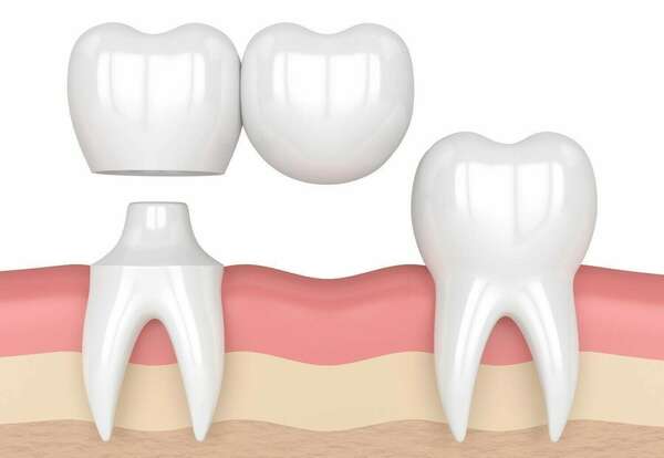 BRIDGE CANTILEVER ET BRIDGE COLLÉ