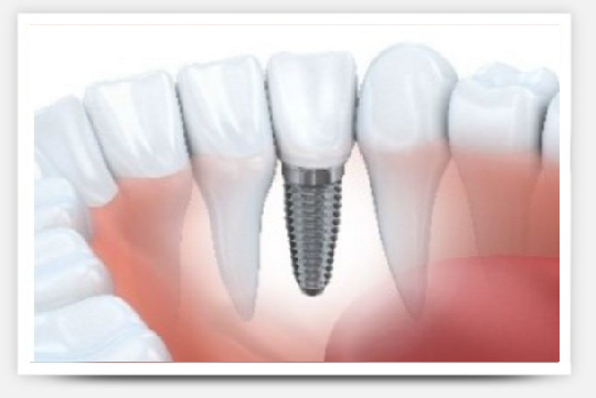 Implants dentaires