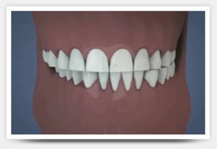 Occlusodontie