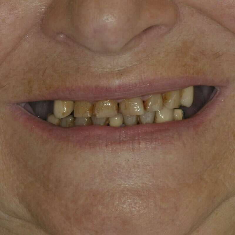 couronnes céramiques avant