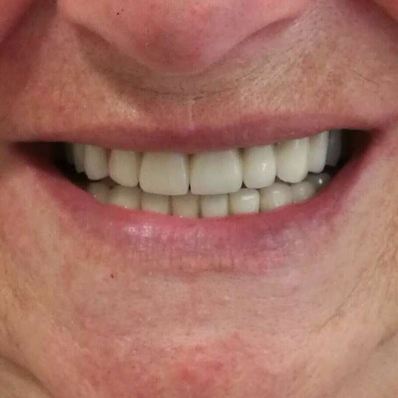 courronnes céramiques après