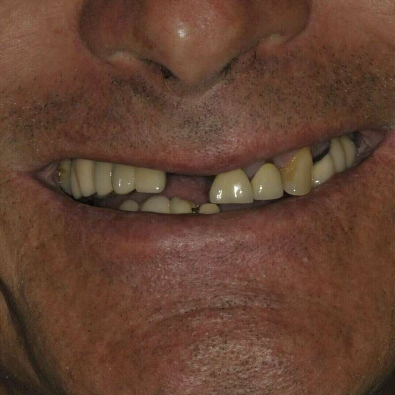 reconstruction globale avant