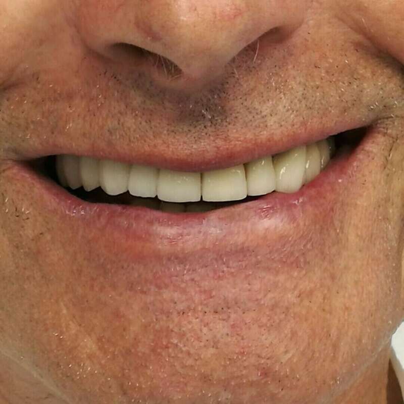 reconstruction globale après