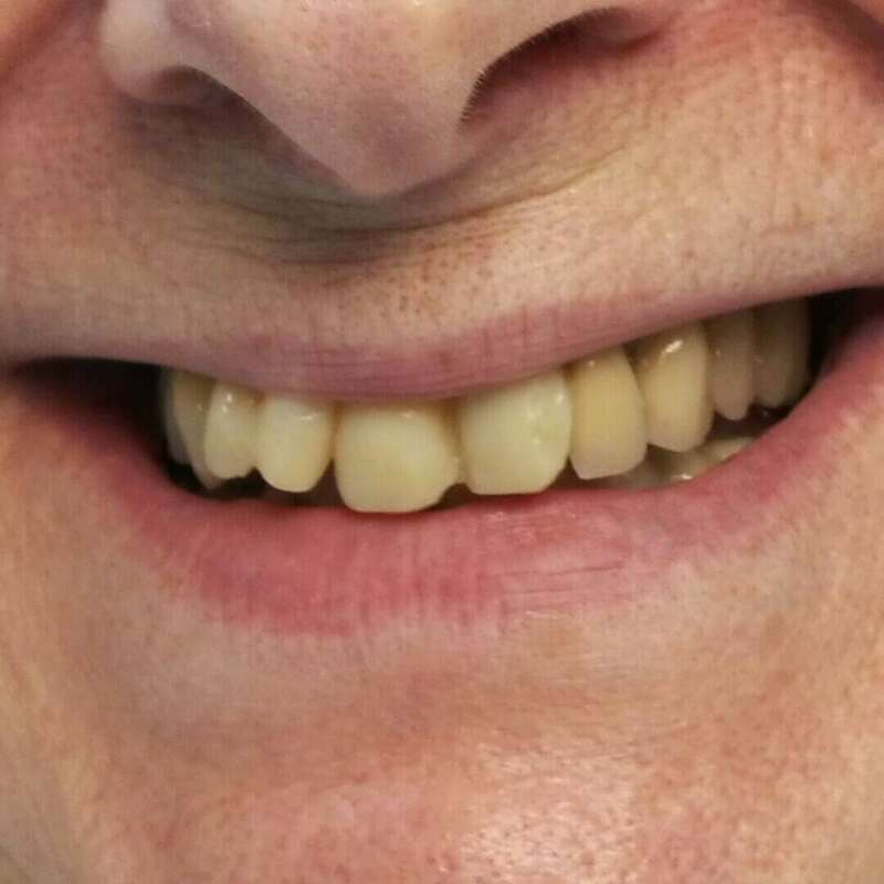 couronne en céramique avant