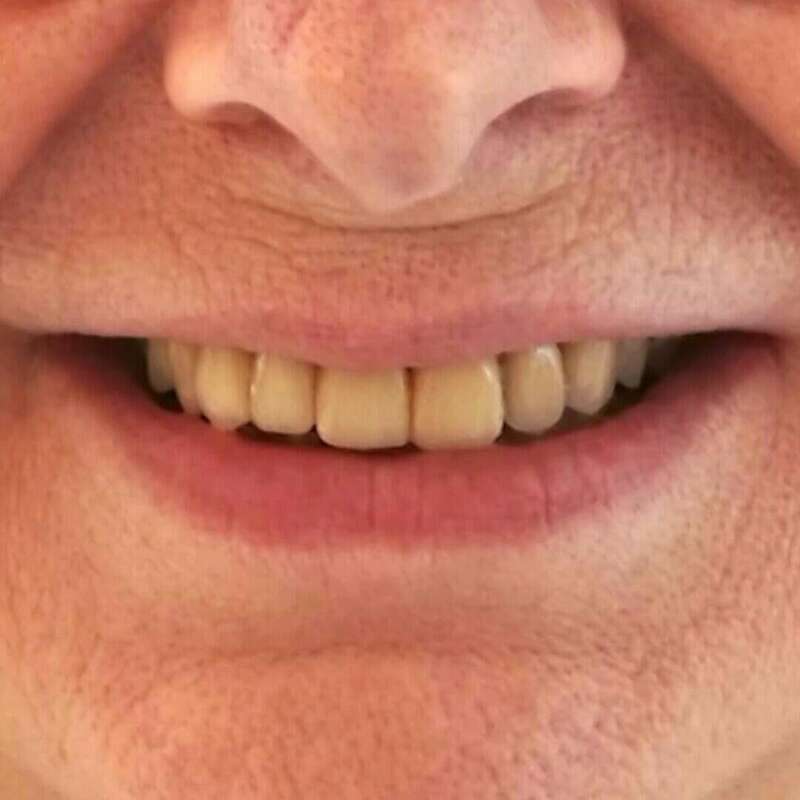 couronne en céramique après