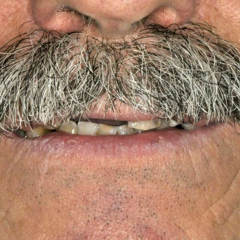 bridge complet avant