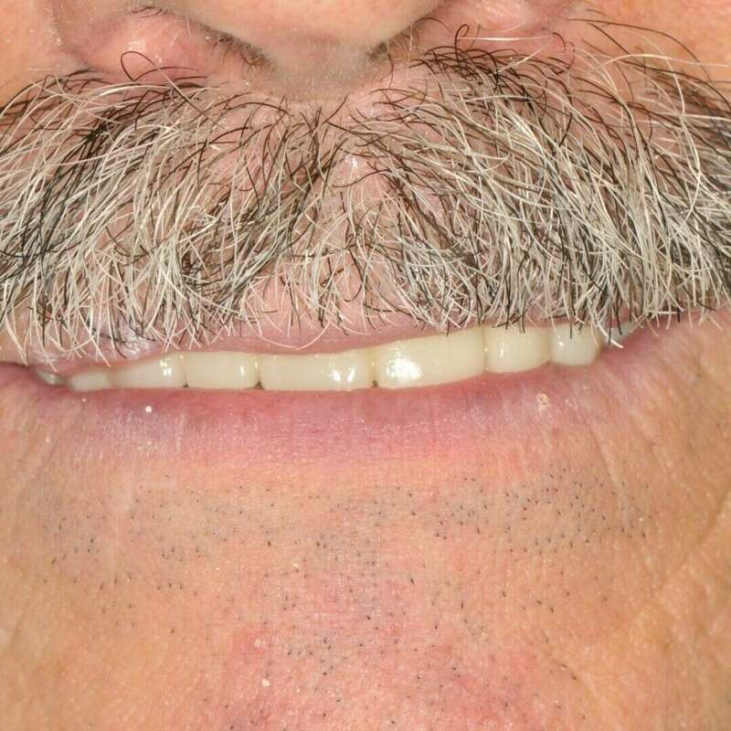 bridge complet après