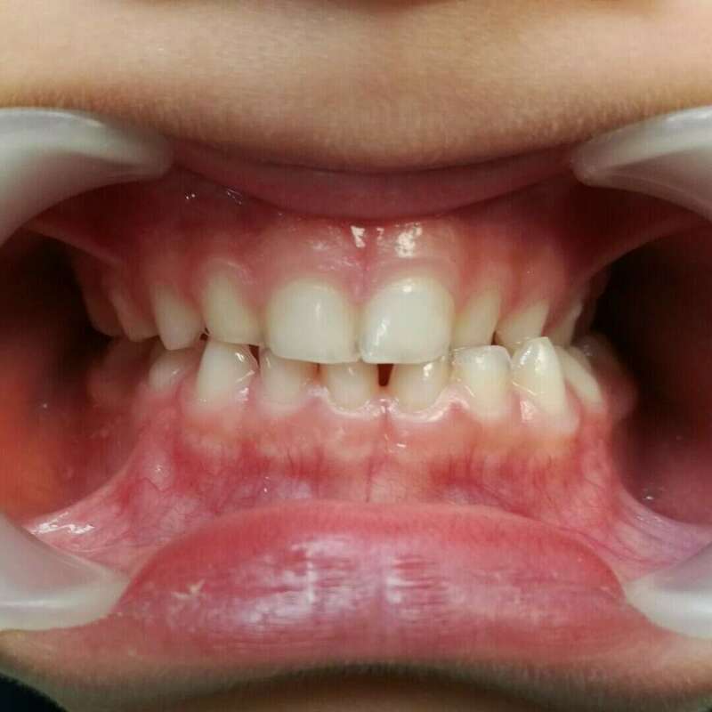 problème d'emboitement des machoires avant