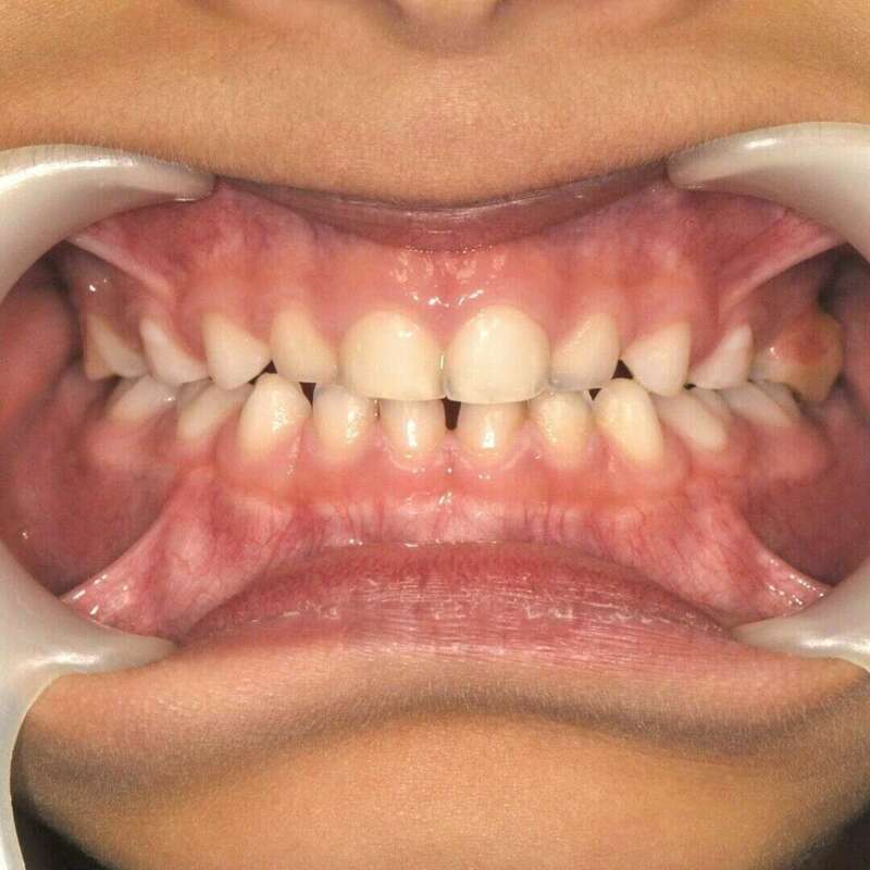 problème d'emboitement des machoires après