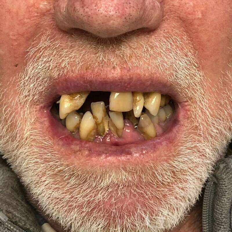 prohtèse complète maxilaire avant