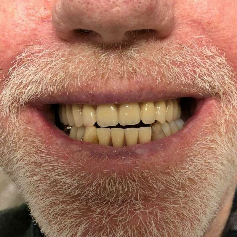 prohtèse complète maxilaire après