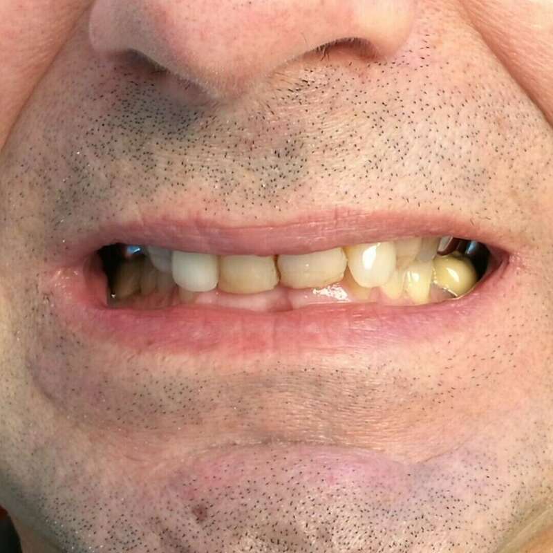 déséquilibre masticatoire avant dents inesthétiques confiance 