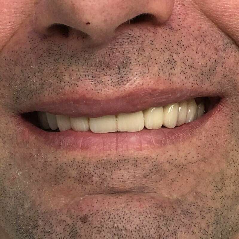 déséquilibre masticatoire après beau sourire équilibré bonne confiance en soir