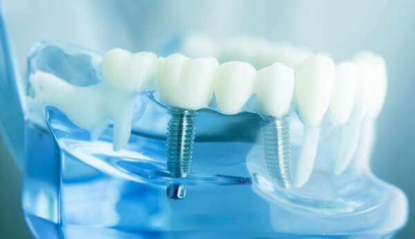 Quelles sont les conséquences d’une dent manquante ? - Balma Sourire