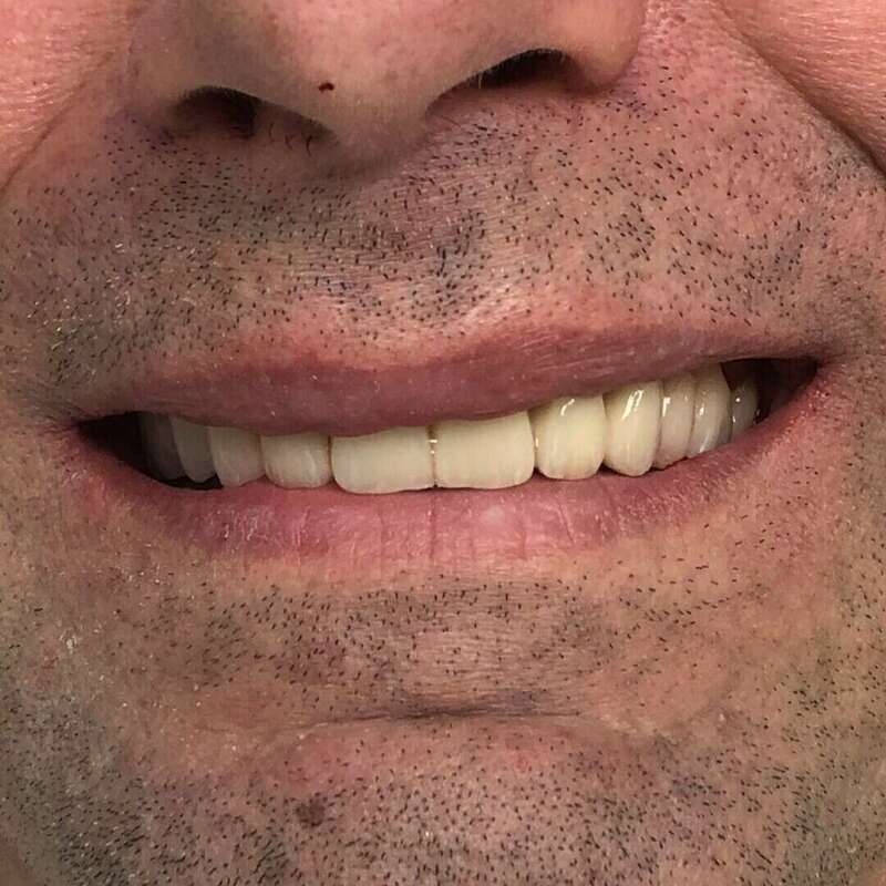 déséquilibre masticatoire après beau sourire équilibré bonne confiance en soir
