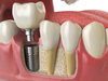 Implant dentaire et sa couronne, vue 3D