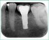 Radiographie d'un implant dentaire posé avec sa couronne