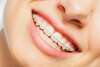 Sourire avec bagues multi-attaches, orthodontie à Balma