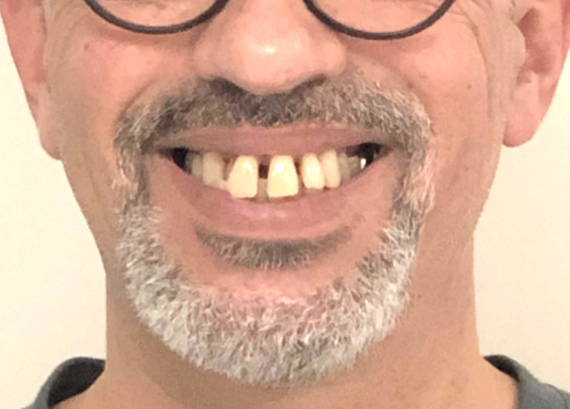 Sourire avant reconstruction globale, patient de 55 ans