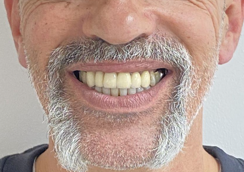 Sourire après reconstruction globale, patient de 55 ans