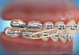 Correction avec élastique classe 2.