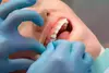 Pose appareil orthodontique