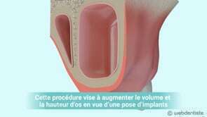 Comblement de sinus par voie latérale (sinus lift) avec implantation différée