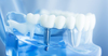 Implant dentaire