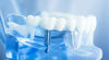 Implant dentaire