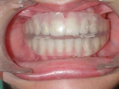 INSTRUCTIONS DE PORT DU POSITIONNEUR DENTAIRE