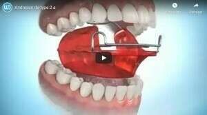 Andresen de type 2 a