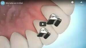 Bite turbo en métal