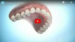 Contention par gouttières