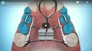 Dijoncteur 2 sur bagues