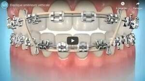 Elastique antérieure verticale